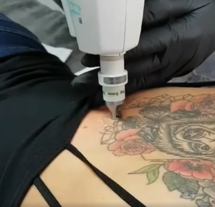 Alma Laser Tattoo Removal 2