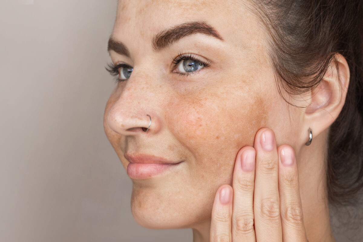portrait cropped caucasian middle aged woman face with freckles touching skin by hand age spots face woman with blue eyes